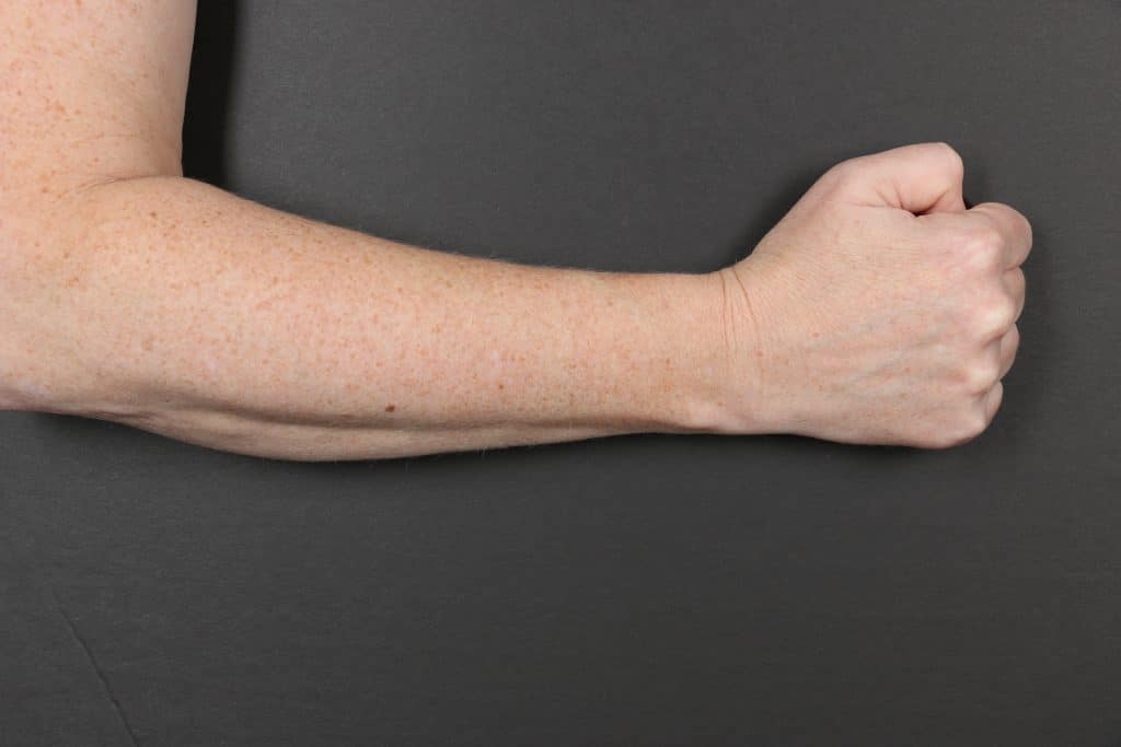 The difference in brown spots on the forearm versus the hand is remarkable. It demonstrates the effectiveness of a SkinCeuticals® antioxidant serum to combat signs of aging, including sun damage.