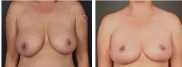 woman’s chest before and after breast lift
