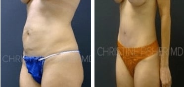woman’s stomach before and after abdominoplasty with flatter stomach after procedure