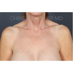 60s female with sun damage to neck and chest